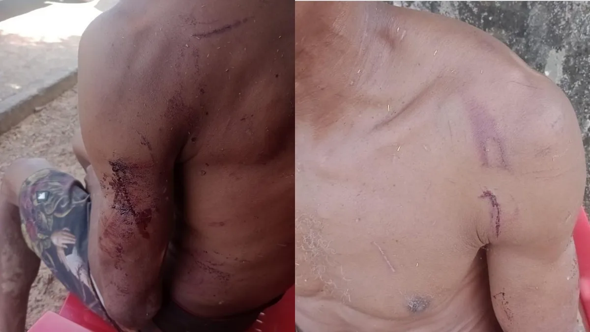 Homem sem camisa com ferimentos provocadosnpor arma de fogo, o tiro atingiu o braço e a bala alojou na costela.