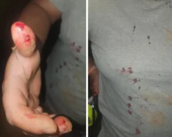 Mulher é mordida na mão