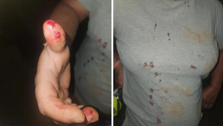 Mulher é mordida na mão