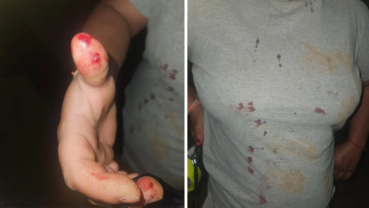 Mulher é mordida na mão